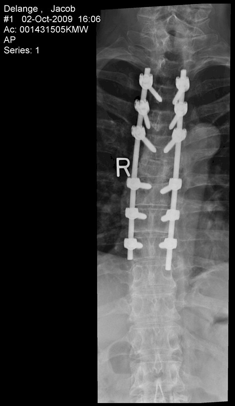 Jacob's spine clearly showing the 2 metal rods placed in his back.